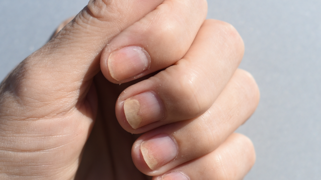 Why Are My Nails Separating? Everything You Need to Know About Onycholysis.