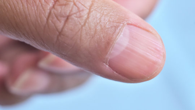 Nail Ridges: Causes and Treatments