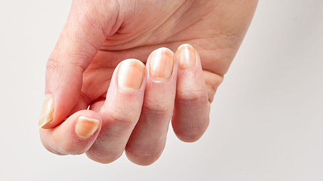 What causes yellow nails?
