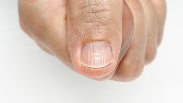 Yes, Your Nails Do Age – Dr. Dana